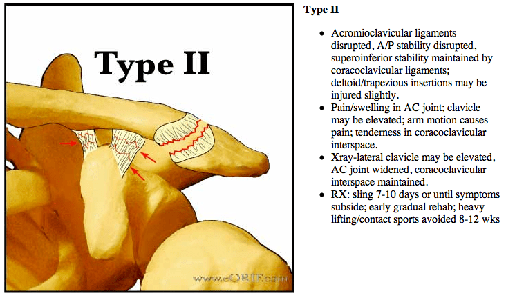 Acromioclavicular Joint Separations S43.109A 831.04 eORIF
